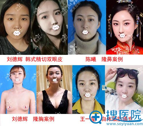 郑州集美双眼皮、隆胸、隆鼻真人案例 郑州集美双眼皮、隆胸、隆鼻真人案例