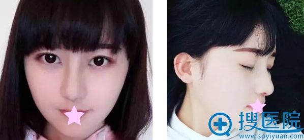 假体隆鼻第10天效果 假体隆鼻第10天效果