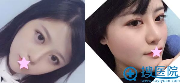 <!--<i data=20240710 data-id=9598></i>-->隆鼻五个月恢复效果 <!--<i data=20240710 data-id=9598></i>-->隆鼻五个月恢复效果