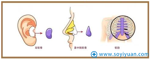 纠结哪种隆鼻材料好?膨体/自体软骨/玻尿酸隆鼻材料和价格表pk