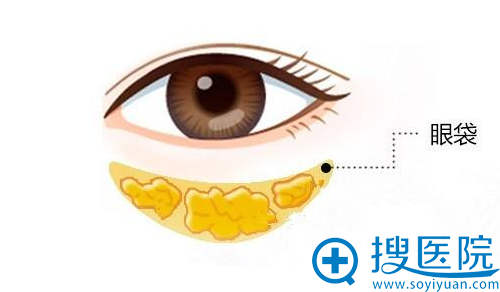 重庆祛眼袋哪家整形医院好?重庆骑士祛眼袋手术案例价格表参考
