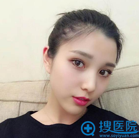 <!--<i data=20240710 data-id=12466></i>-->整形医院薛塬峰做的双眼皮案例 <!--<i data=20240710 data-id=12466></i>-->整形医院薛塬峰做的双眼皮案例