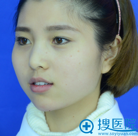 在<!--<i data=20240710 data-id=12466></i>-->做双眼皮手术前 在<!--<i data=20240710 data-id=12466></i>-->做双眼皮手术前