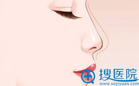 针对表妹提出的北京做假体隆鼻多少钱问题我是这样回答的