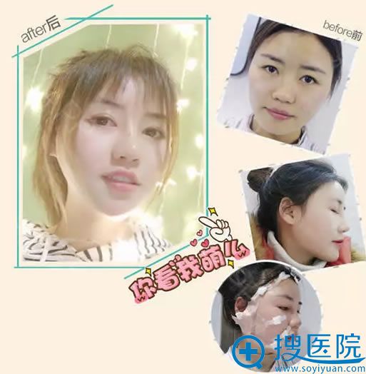 昆明悦格<!--<i data=20240710 data-id=16773></i>-->院长做脂肪填充案例 昆明悦格<!--<i data=20240710 data-id=16773></i>-->院长做脂肪填充案例