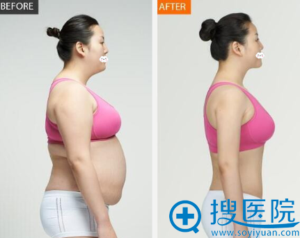 体型偏胖的我想问下吸脂减肥价格多少钱?