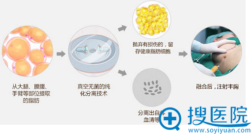 自体脂肪隆胸手术过程图 自体脂肪隆胸手术过程图