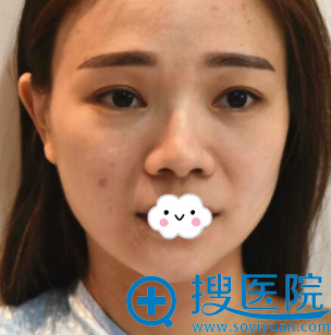 将我假体隆鼻术失败修复的经验和价格分享给鼻整形失败的你