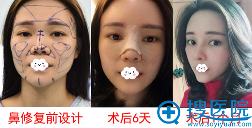 假体隆鼻失败到深圳美莱梁晓健处做自体软骨隆鼻修复 假体隆鼻失败到深圳美莱梁晓健处做自体软骨隆鼻修复