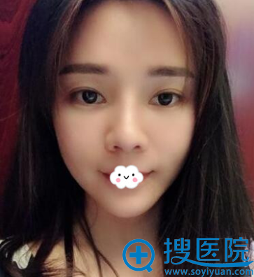 假体隆鼻失败怎么办?隆鼻失败修复案例过程图 假体隆鼻失败怎么办?隆鼻失败修复案例过程图