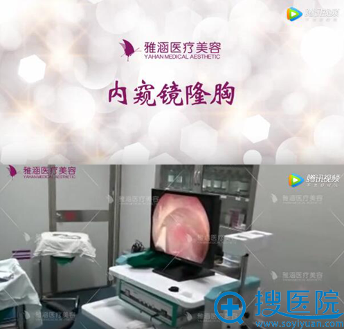 深圳雅涵内窥镜隆胸展示 深圳雅涵内窥镜隆胸展示