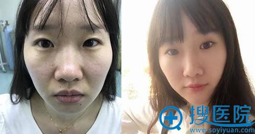 我注射玻尿酸填充和除皱前后效果 我注射玻尿酸填充和除皱前后效果