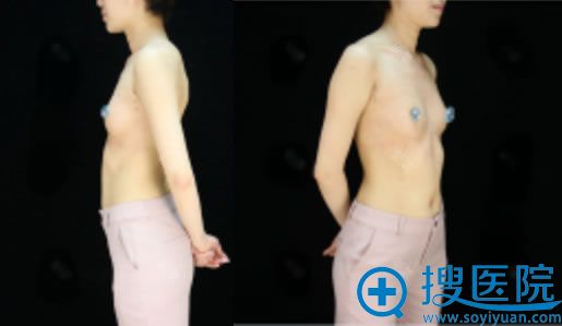想哺乳后丰胸于是问同事北京隆胸手术医生高超和曾昂对比哪个好