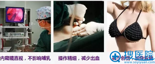 <!--<i data=20240710 data-id=14690></i>-->华美整形内窥镜假体隆胸过程 <!--<i data=20240710 data-id=14690></i>-->华美整形内窥镜假体隆胸过程