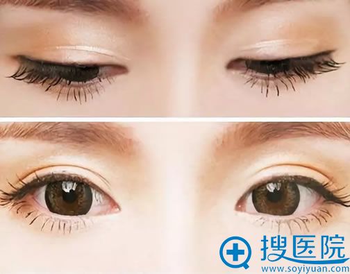 针对近期咨询做双眼皮手术爱美者的常见问题清单整理如下