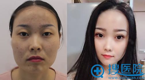 做双眼皮手术案例效果对比图 做双眼皮手术案例效果对比图