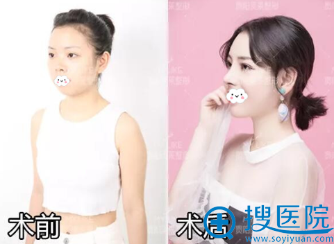 达拉斯鼻整形院长胡凯9月19-20日坐诊贵阳美莱解析隆鼻后遗症
