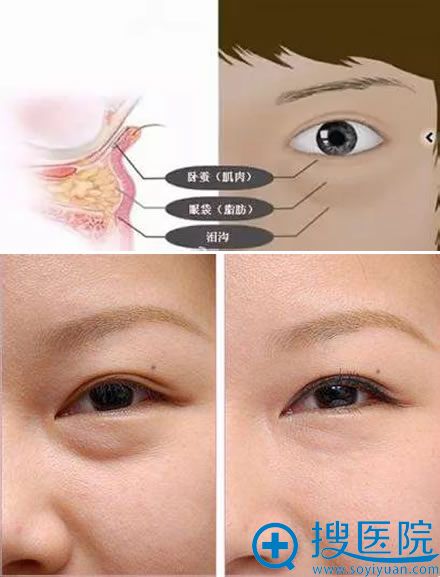 眼袋的形成原因和影响 眼袋的形成原因和影响