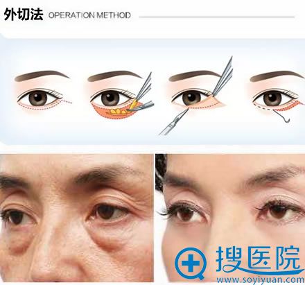 外切法去眼袋手术过程和案例效果 外切法去眼袋手术过程和案例效果
