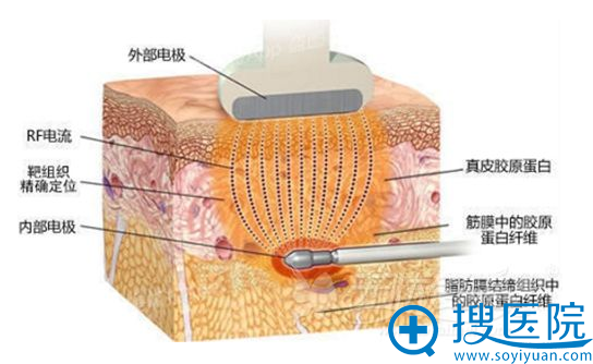 通过激光溶脂案例和价格表来告诉你激光溶脂多少钱?效果好吗?