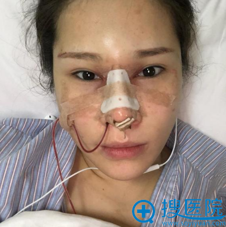 <!--<i data=20240710 data-id=16406></i>-->博士肋软骨鼻综合隆鼻手术天 <!--<i data=20240710 data-id=16406></i>-->博士肋软骨鼻综合隆鼻手术天