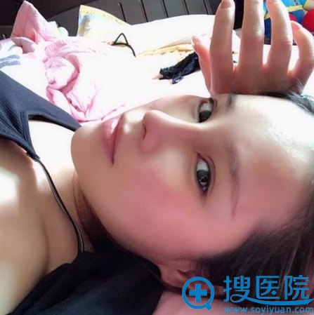 肋软骨鼻综合隆鼻修复手术十天效果图 肋软骨鼻综合隆鼻修复手术十天效果图