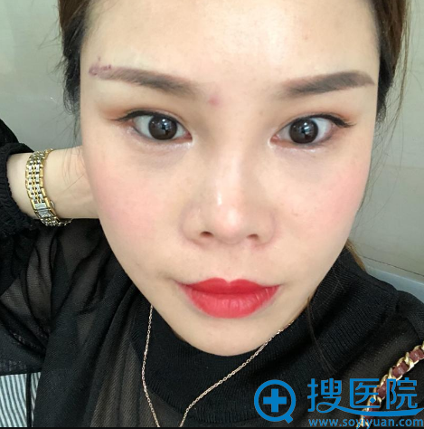看了上海伊莱美钱玉鑫的隆鼻案例后决定找他为我做隆鼻失败修复