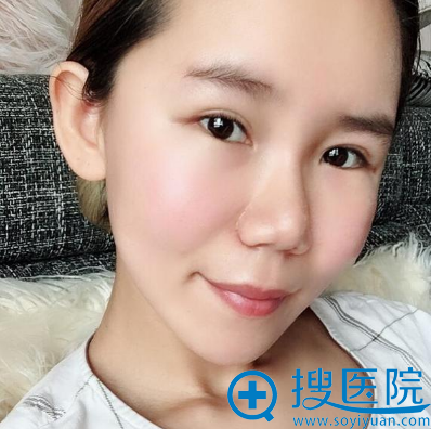 <!--<i data=20240710 data-id=13409></i>-->刘中国做的自体脂肪全脸填充手术案例 <!--<i data=20240710 data-id=13409></i>-->刘中国做的自体脂肪全脸填充手术案例