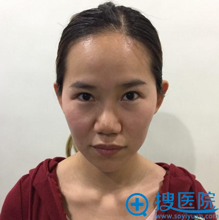 对比了成都玉之光和铜雀台后选择刘中国做了自体脂肪面部填充