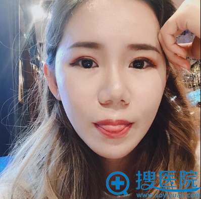 <!--<i data=20240710 data-id=12005></i>-->刘中国自体脂肪填充案例两个月 <!--<i data=20240710 data-id=12005></i>-->刘中国自体脂肪填充案例两个月