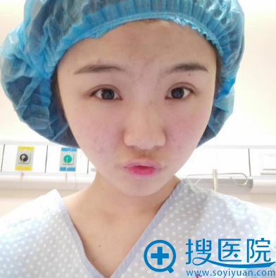 之前在南京美莱找陈天杰做过双眼皮这次来找赵其中做隆鼻和填充
