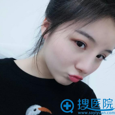 <!--<i data=20240710 data-id=15771></i>-->陈天杰双眼皮和赵其中隆鼻案例 <!--<i data=20240710 data-id=15771></i>-->陈天杰双眼皮和赵其中隆鼻案例
