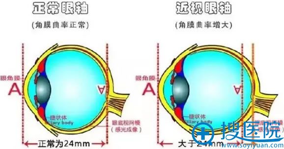 近视眼的形成原因剖析图 近视眼的形成原因剖析图