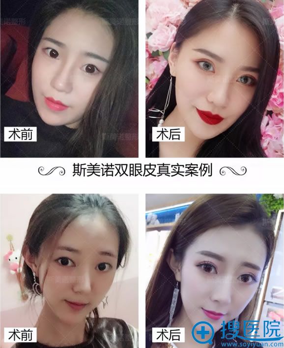 锦州斯美诺耿成虎割双眼皮案例 锦州斯美诺耿成虎割双眼皮案例