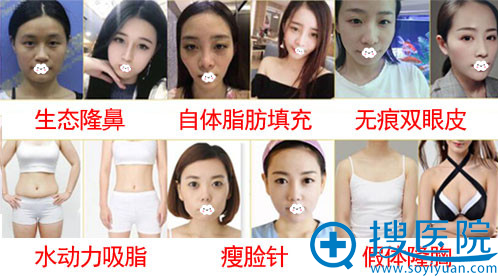 深圳弘美双眼皮/隆鼻/隆胸案例效果对比图 深圳弘美双眼皮/隆鼻/隆胸案例效果对比图
