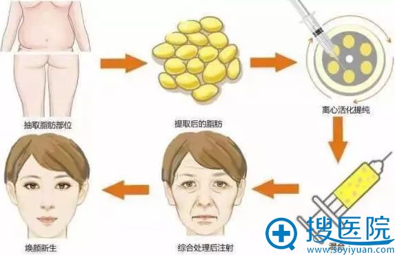 很多爱美者想知道自体脂肪填充是的吗,现在就明确告诉你