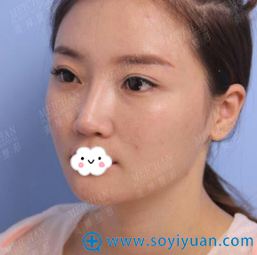 朋友在重庆美禅让吴一做双眼皮修复时说他隆鼻修复也挺好我才来