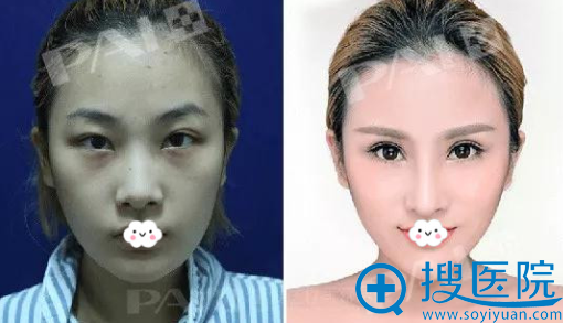 真人案例图了解玻尿酸和瘦脸除皱除皱效果哪个更好?价格是多少
