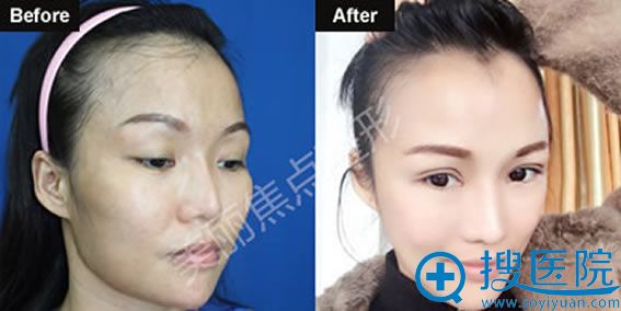 桂林美丽焦点陈毓南双眼皮案例 桂林美丽焦点陈毓南双眼皮案例