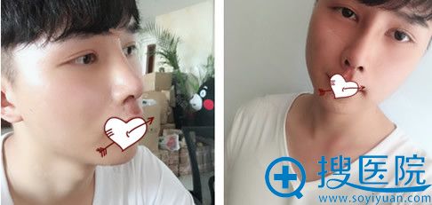 包头华美整形肋软骨隆鼻术后第8天照片 包头华美整形肋软骨隆鼻术后第8天照片
