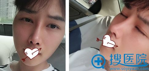 找白虎做肋软骨隆鼻术后第18天效果图 找白虎做肋软骨隆鼻术后第18天效果图