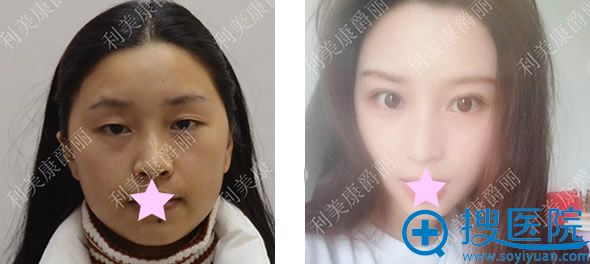 成都利美康面部综合整形效果 成都利美康面部综合整形效果