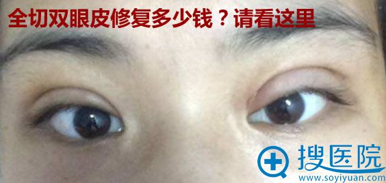 全切双眼皮修复多少钱?公布南京华美双眼皮整形失败修复价格表