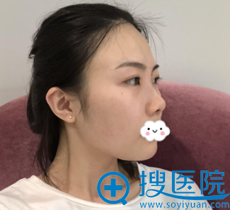 我的美丽蜕变来自福州海峡林秀兰假体+自体肋软骨隆鼻综合整形