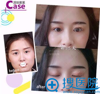 深圳美莱双眼皮真人案例效果图对比 深圳美莱双眼皮真人案例效果图对比