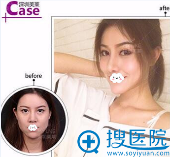 深圳美莱隆鼻效果怎么样?真人鼻综合案例对比 深圳美莱隆鼻效果怎么样?真人鼻综合案例对比