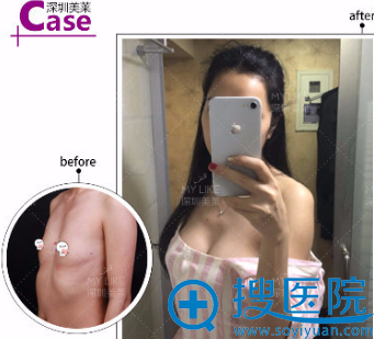 深圳美莱假体隆胸真人案例效果对比图 深圳美莱假体隆胸真人案例效果对比图