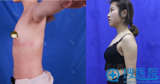 找北京丽都高超做假体隆胸前 找北京丽都高超做假体隆胸前