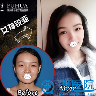 <!--<i data=20240710 data-id=13979></i>-->割双眼皮真人案例效果对比图 <!--<i data=20240710 data-id=13979></i>-->割双眼皮真人案例效果对比图