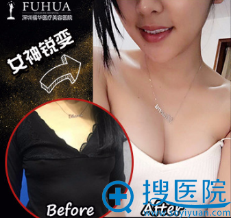 <!--<i data=20240710 data-id=13979></i>-->假体隆胸效果怎么样?真人案例对比图 <!--<i data=20240710 data-id=13979></i>-->假体隆胸效果怎么样?真人案例对比图